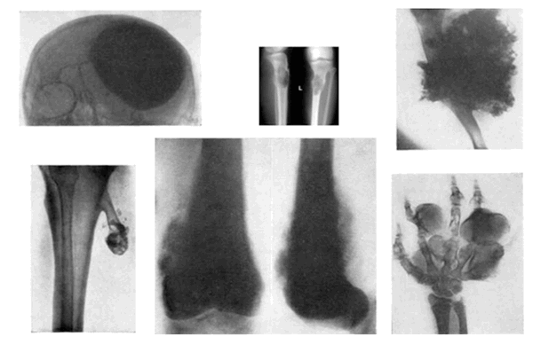 Рис.1: Варианты локализации остеосаркомы