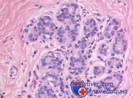 рак влагалища