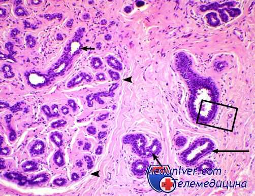 опухоль молочной железы