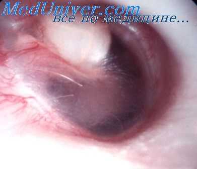 меланома наружного слухового прохода
