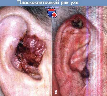 Плоскоклеточный рак уха