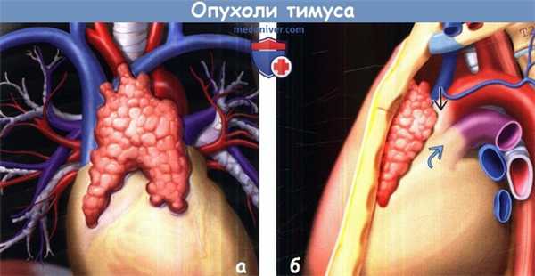 Схема тимуса в норме