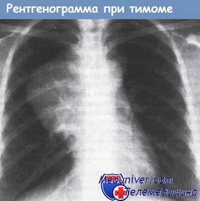 Рентгенограмма при тимоме