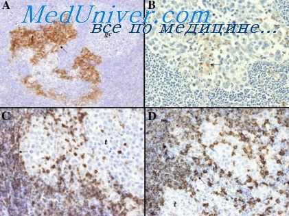 злокачественнй тимомы