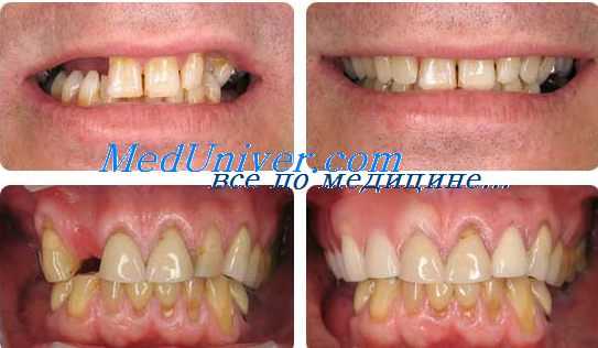 протезные парадонтиты