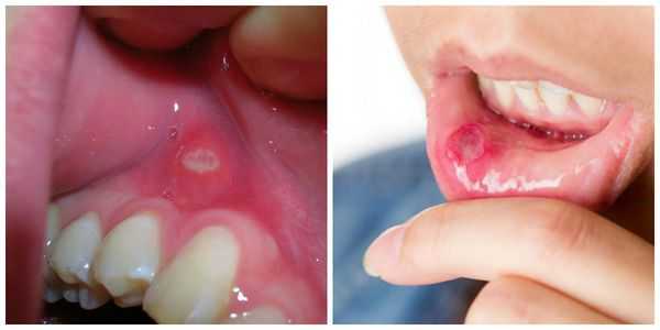 Язвы на слизистой полости рта