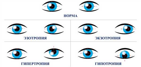 виды косоглазия
