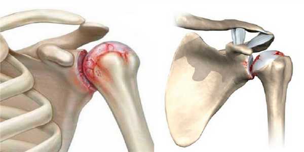 Посттравматический артроз плечевого сустава