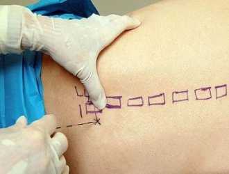 Что такое спинальная анестезия?