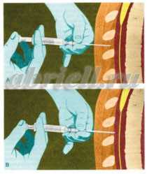 Продвижение иглы в эпидуральное пространство в объёмном изображении.