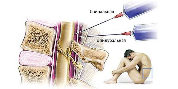 Обратите внимание чем отличается спинальная от эпидуральной анастезии