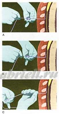 Продвижение иглы в эпидуральное пространство в объёмном изображении.