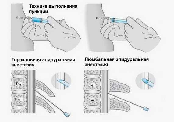 Введение анестетика может проводится в разных частях позвоночника, в зависимости от пораженного участка