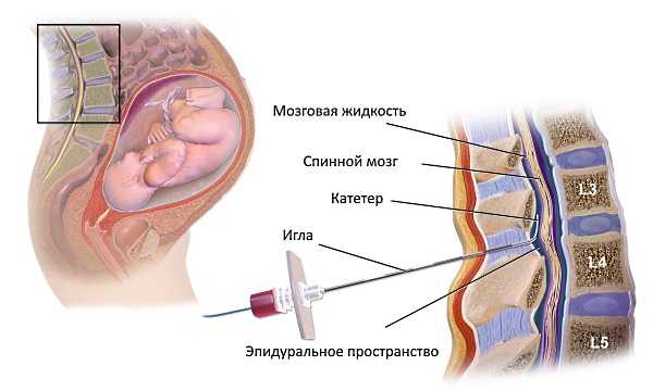 Часто спинальную анестезию применяют при кесаревом сечении