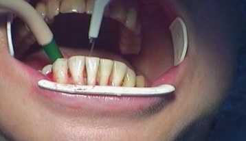 shinirovaniye pri parodontite