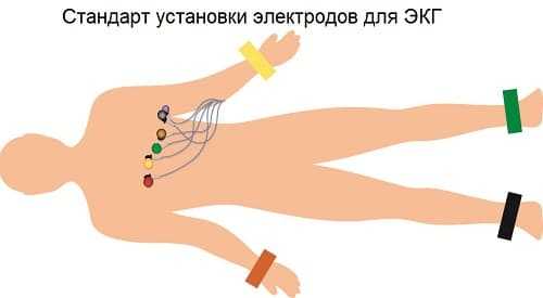 Схема установки грудных электродов