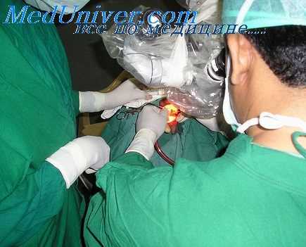 антромастоидэктомия