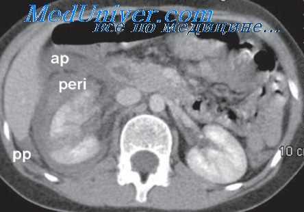 искусственный паралич диафрагмы
