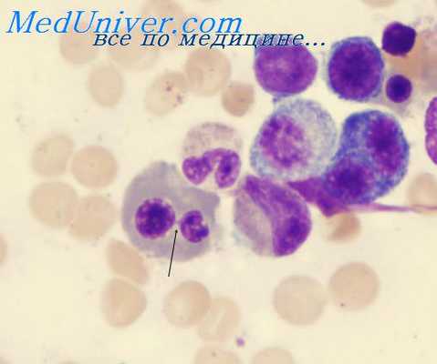 внутрисосудистый гемолиз