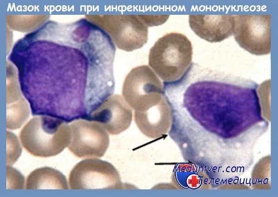 Мазок крови при инфекционном мононуклеозе