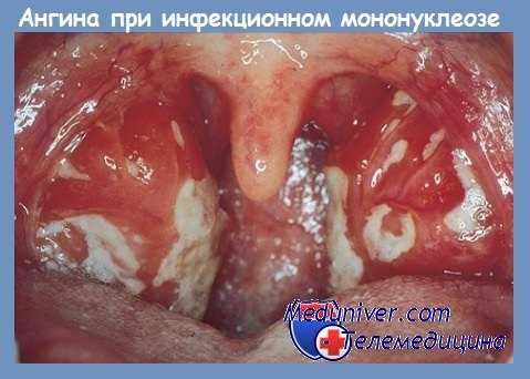 Ангина при инфекционном мононуклеозе
