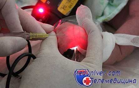 установка периферического катетера у ребенка