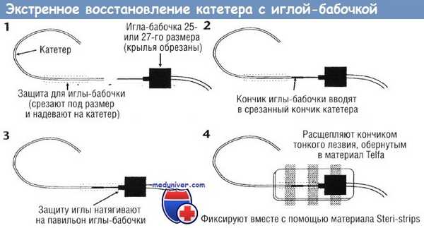 Экстренное восстановление центрального венозного катетера