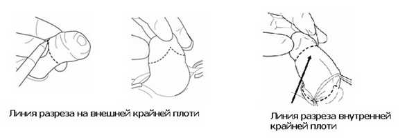 Метод циркулярной резекции