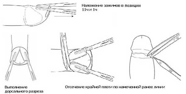 Метод дорсального разреза