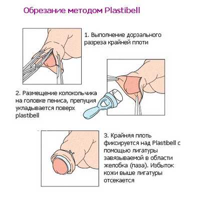В процессе данной процедуры удаляется лишь крайняя плоть