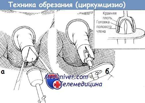 Методика обрезания (циркумцизио)