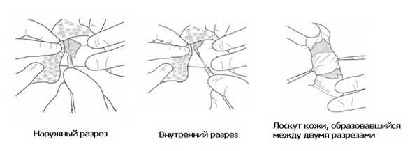 Далее образовавшийся лоскут