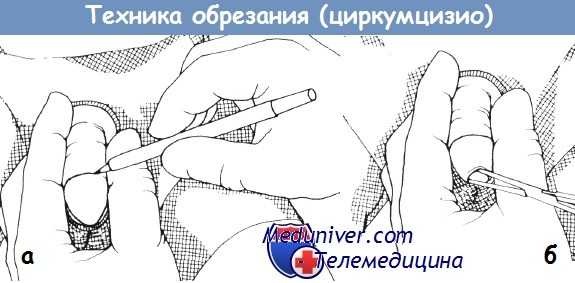 Методика обрезания (циркумцизио)