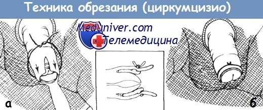 Методика обрезания (циркумцизио)