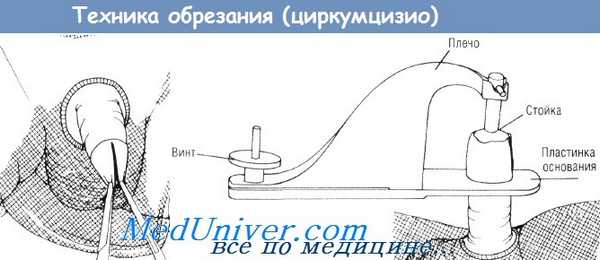 Методика обрезания (циркумцизио)