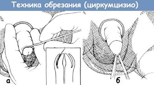 Методика обрезания (циркумцизио)
