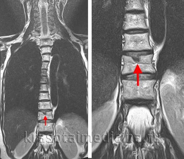 Грыжа Шморля