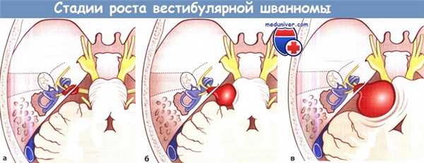 Стадии роста вестибулярной шванномы