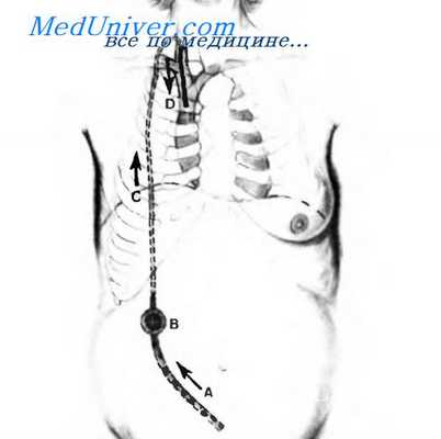 осложнения перитонеовенозного шунта