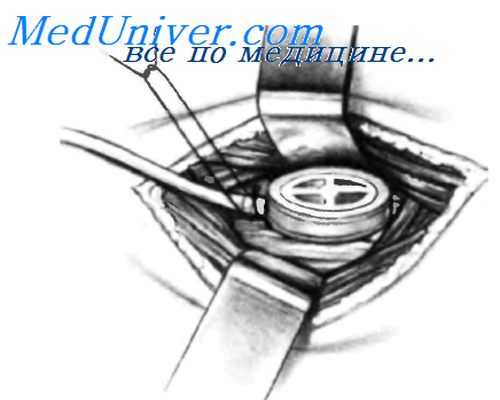 техника установки перитонеовенозного шунта LeVeen