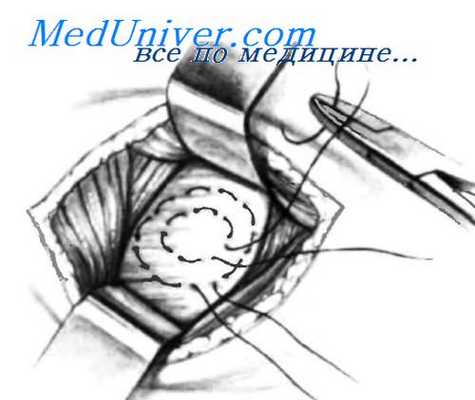 методика установки перитонеовенозного шунта LeVeen