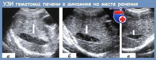 гематома печени на месте ранения в динамике