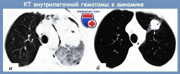 КТ внутрилегочной гематомы