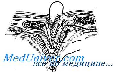 ушивание ран