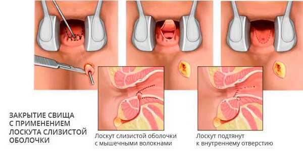 Закрытие свища с применением лоскута слизистой оболочки