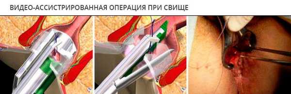 Видео-ассистрированная операция при свище