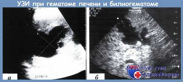 УЗИ при гематоме печени и билиогематоме