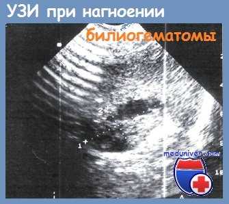 УЗИ при нагноении билиогематомы