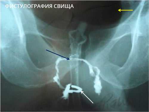 Фистулография свища