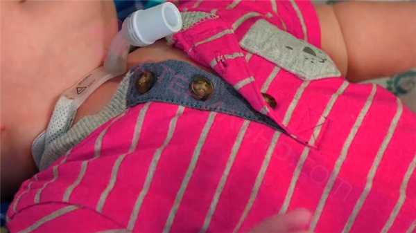 Трахеостома у детей